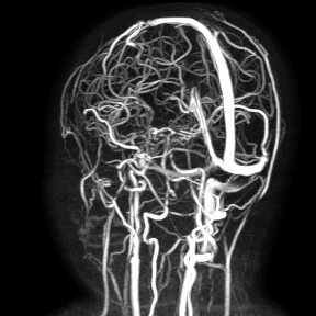 Recupera la vista bimba di 10 anni con paralisi oculare operata a Bari