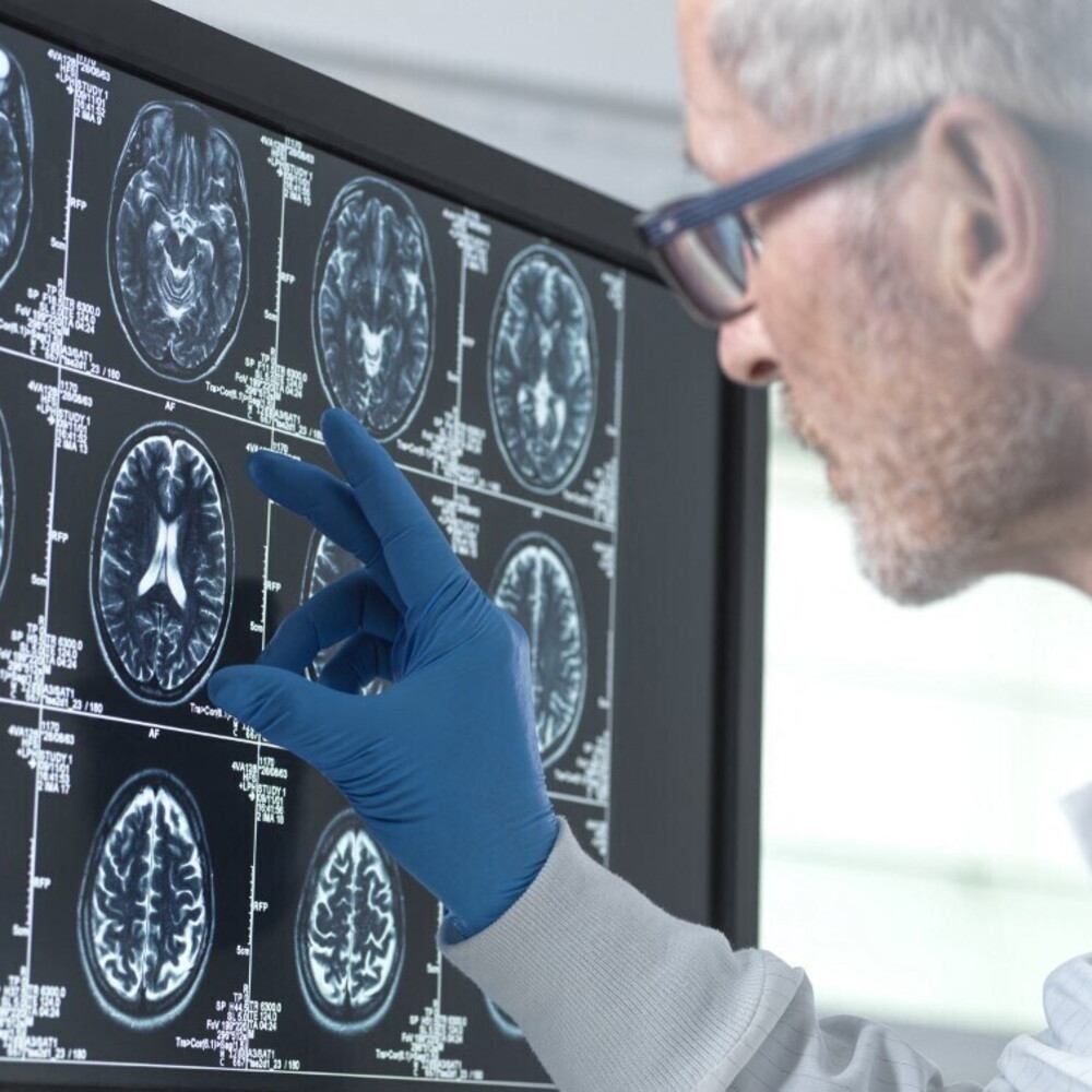 L'accumulo di proteine nei vasi cerebrali anticipa la demenza