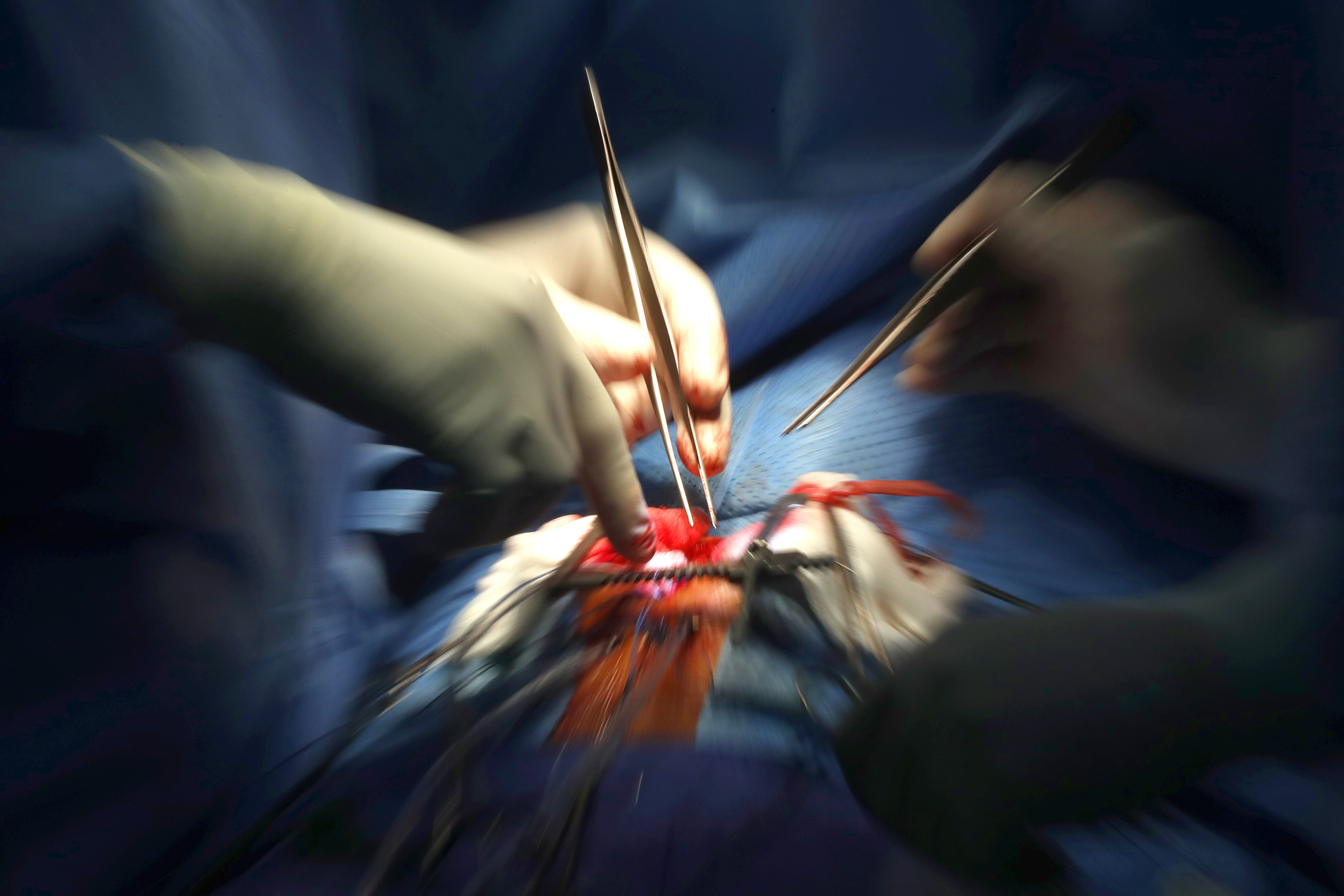 Il cardiochirurgo: sul trapianto del bimbo di Napoli "errori inconcepibili"