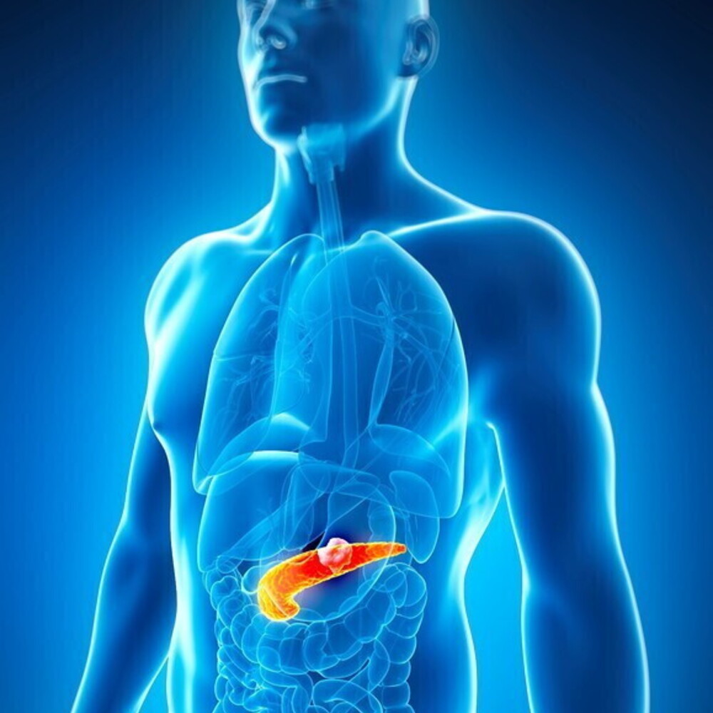 Tumore al pancreas, la fuga immunitaria inizia presto