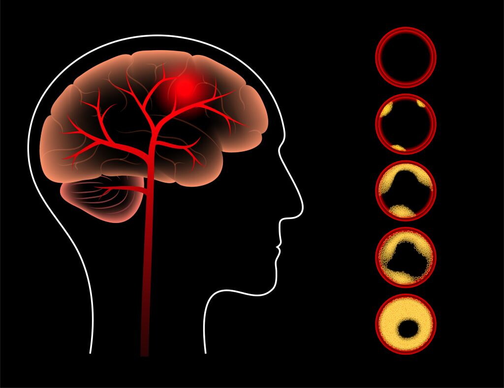 Ridurre l’età biologica protegge il cervello dal rischio di ictus