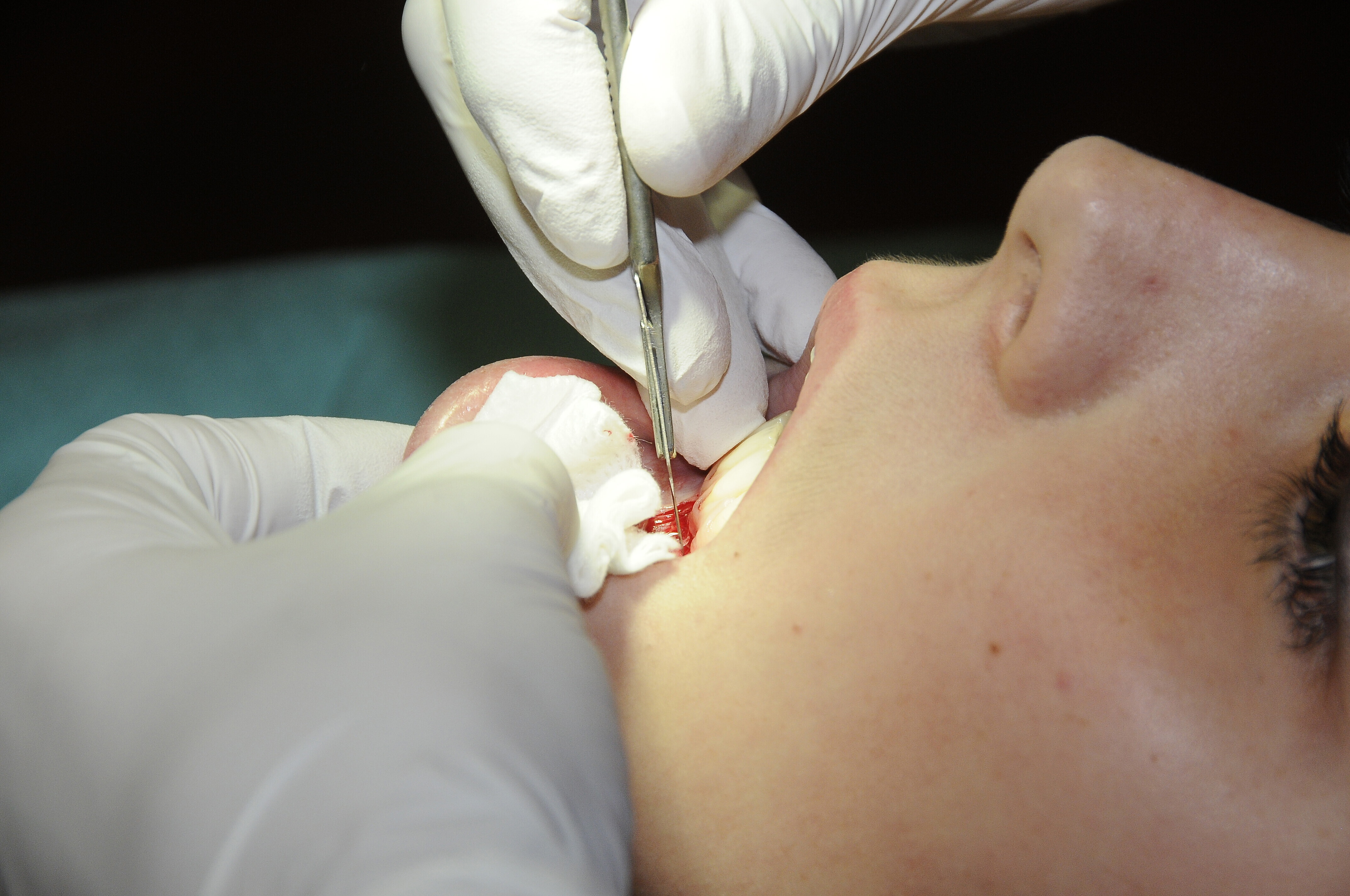 Smog e caldo minacciano anche la salute orale