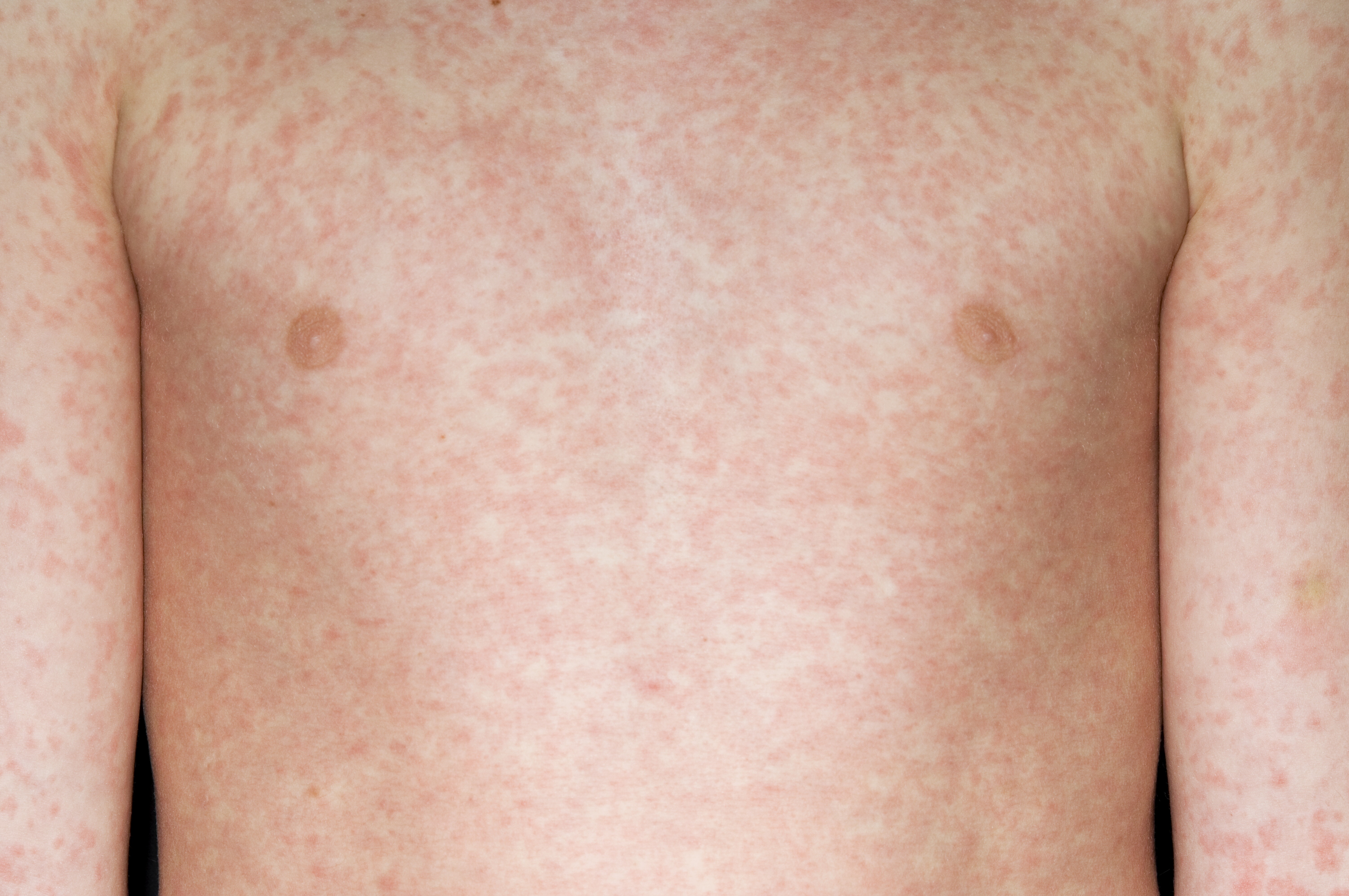 Nuovi anticorpi monoclonali contro il morbillo