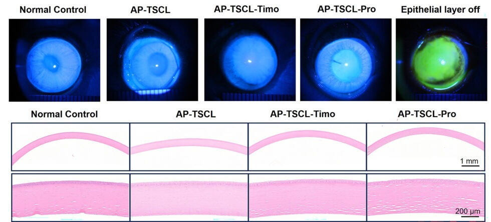 Contro il glaucoma arriva la lente a contatto “intelligente”