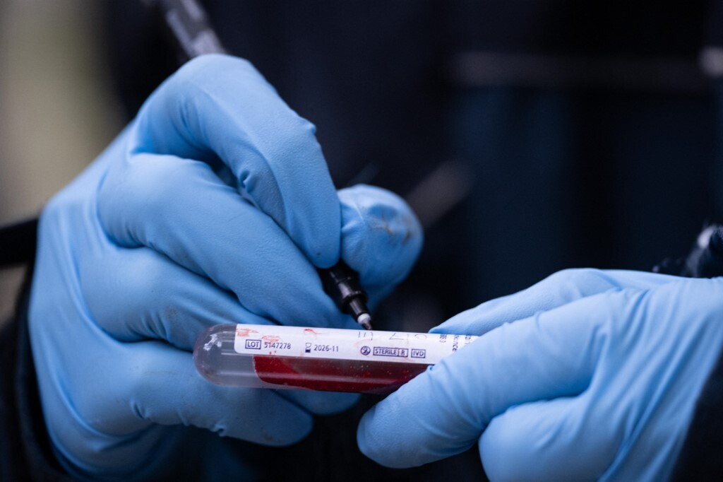 Svolta per l'Alzheimer: diagnosi precoce con un test del sangue