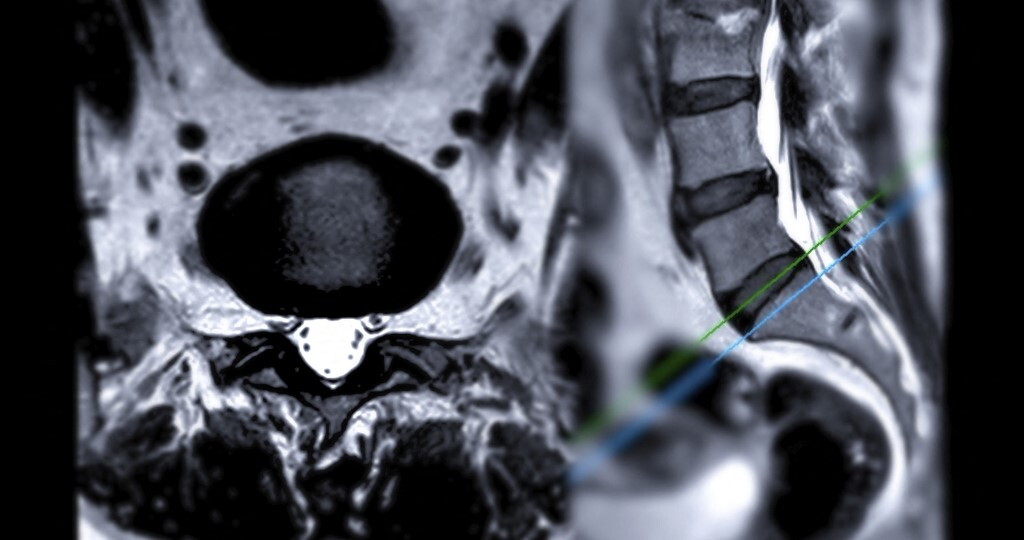 Un anticorpo può rigenerare il midollo spinale dopo un trauma