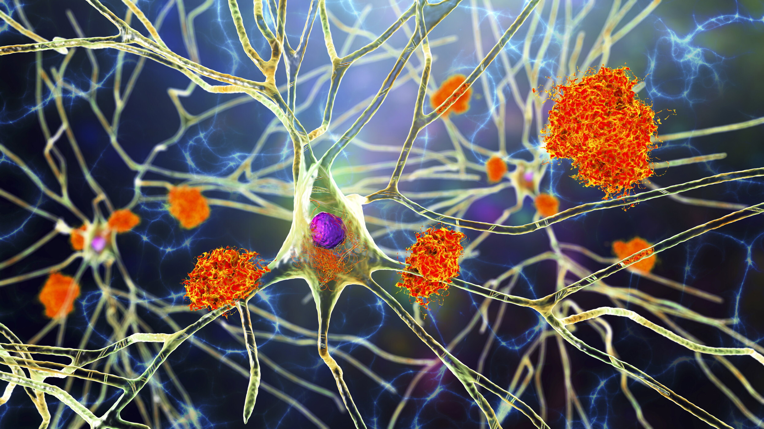 Alzheimer, un nuovo studio svela come si innesca nel cervello