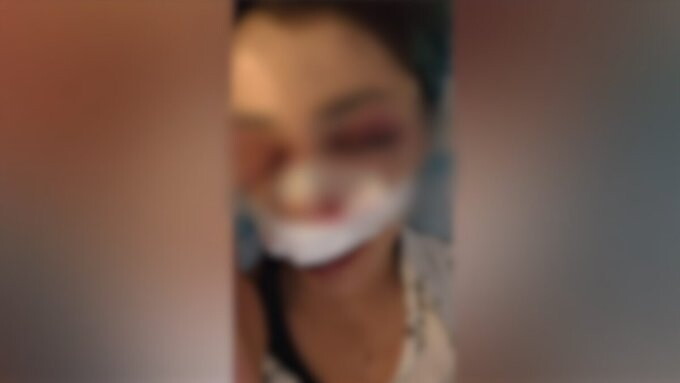 Ragazza ferita seduta in ospedale con bende al volto dopo aggressione notturna in parco cittadino