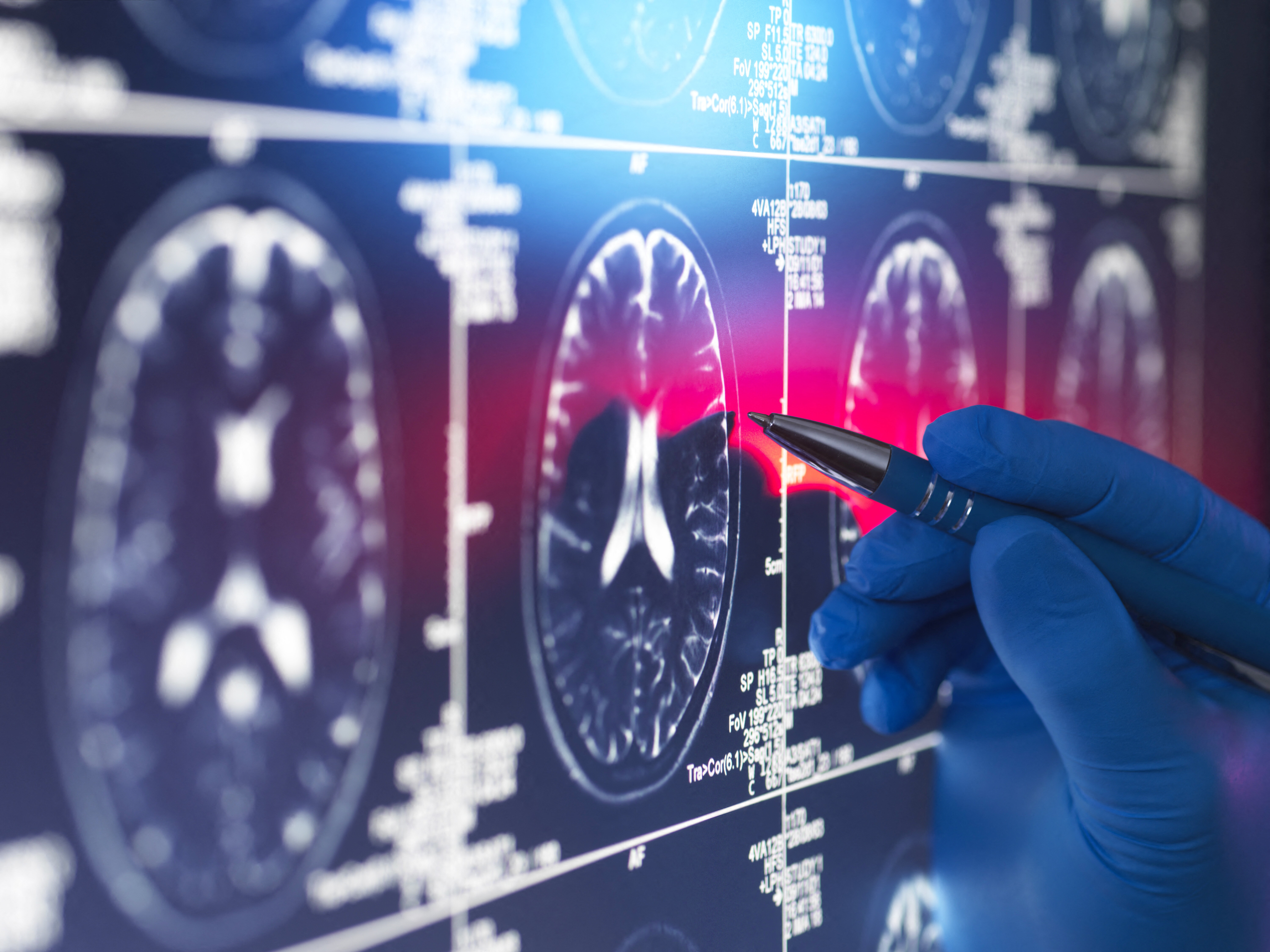 Consumare meno zucchero da piccoli riduce rischio di demenza