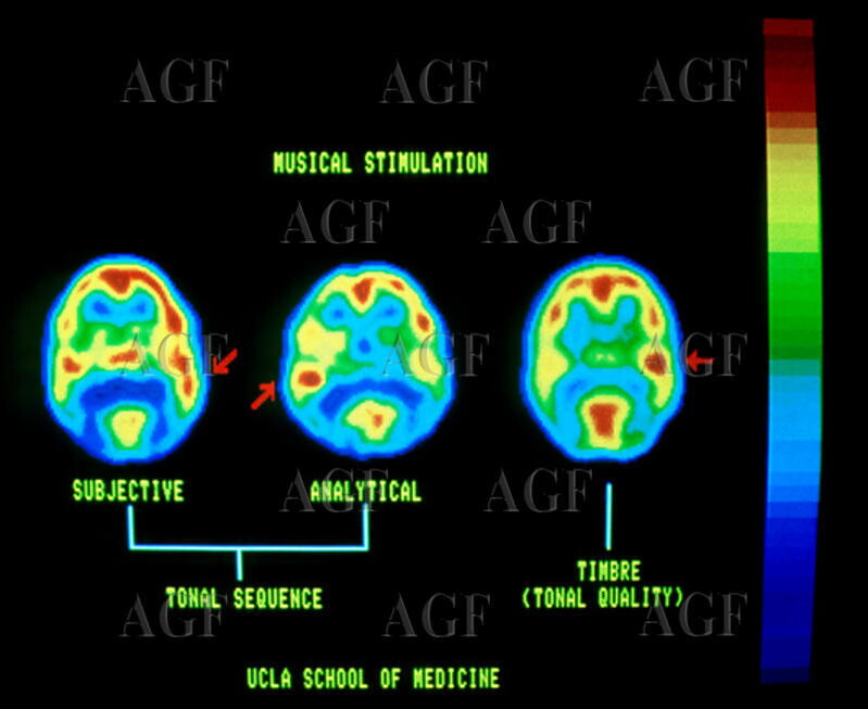 L'attività cerebrale rivela le melodie immaginate dalle persone