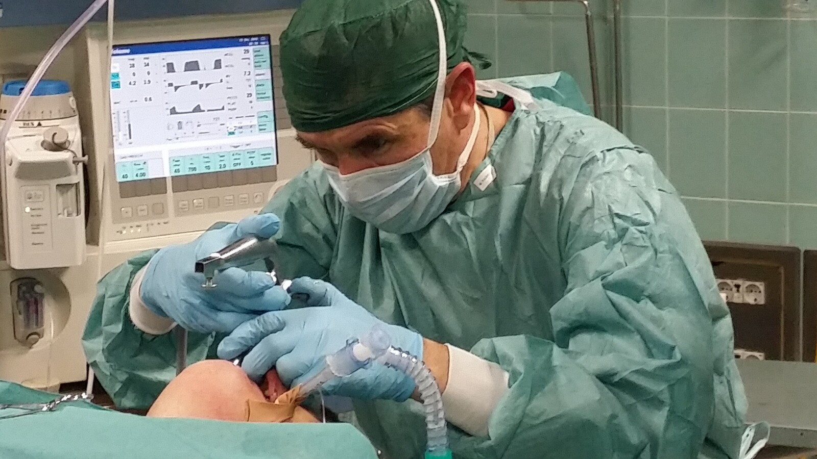 Una nocciola nei bronchi per due settimane, salvata una bimba di 20 mesi
