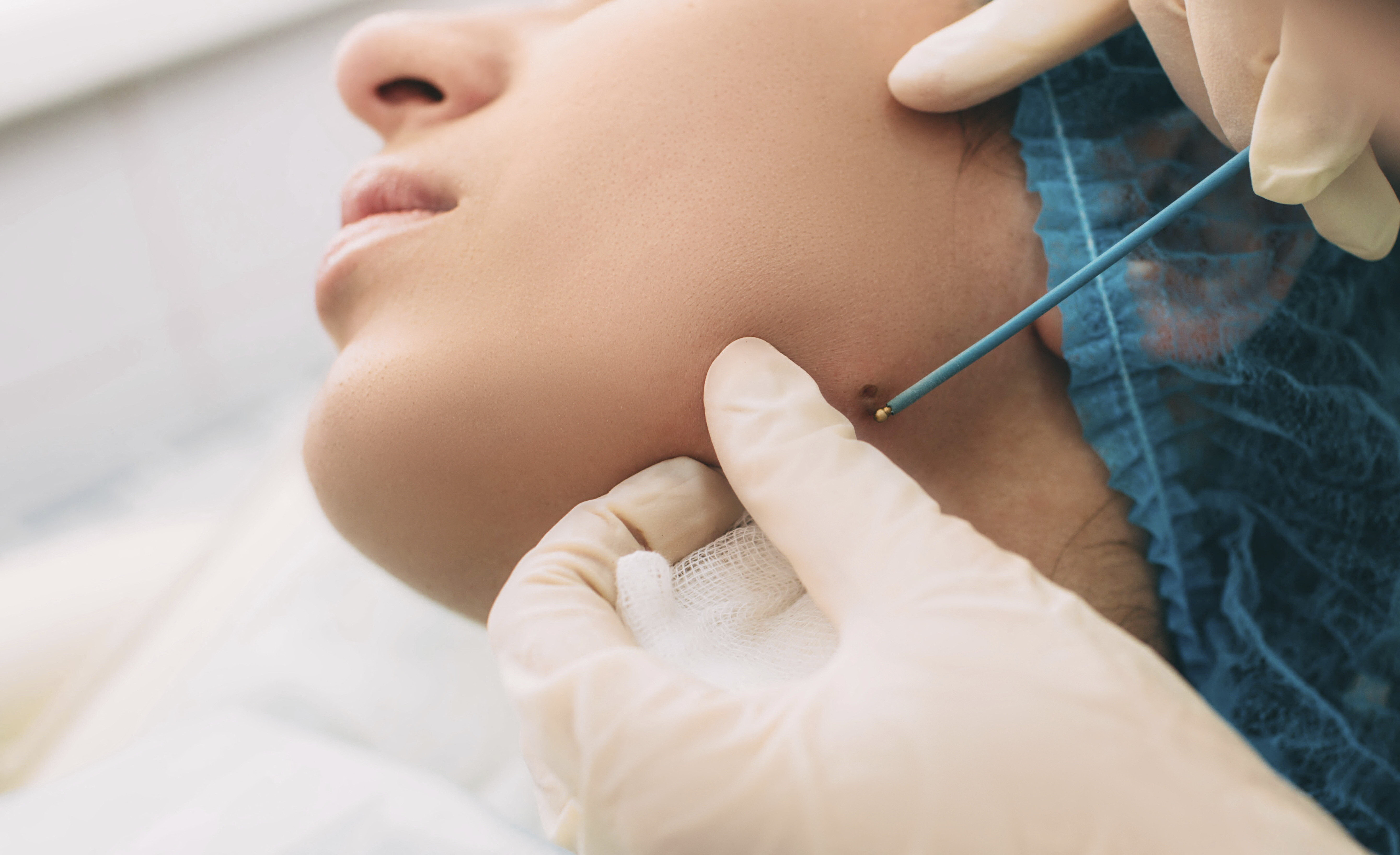 Risultati positivi per il vaccino contro il cancro della pelle: l'annuncio di Moderna e Merck