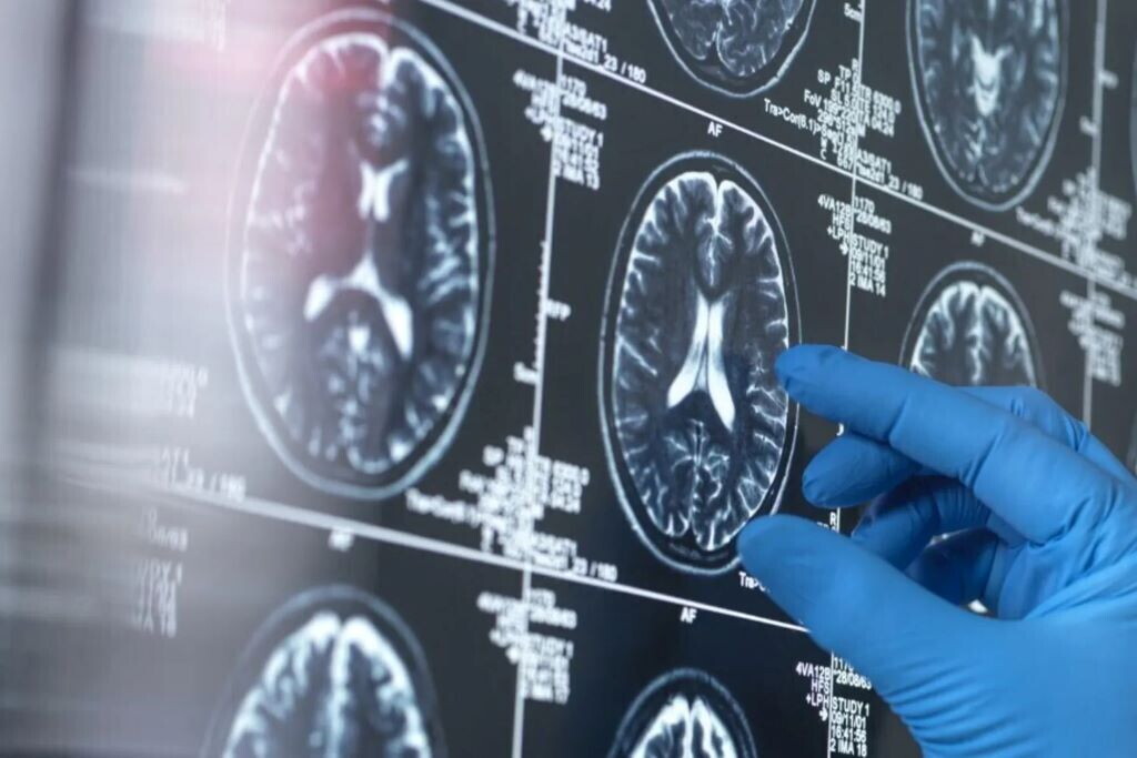 Alzheimer, la svolta dello spray nasale: frena il declino e protegge la memoria